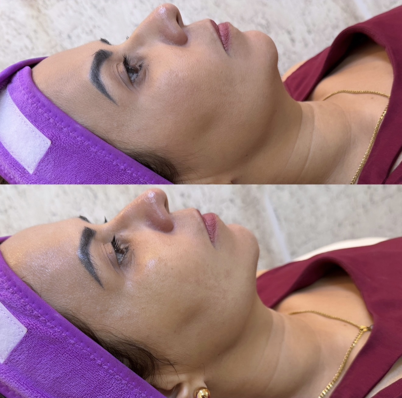 Resultado antes e depois